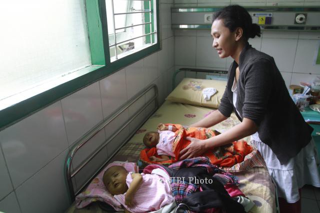Calista dan Mikhayla yang baru berumur 6,5 bulan menderita Allagile Syndrome