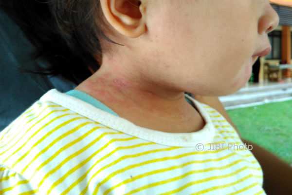 Salah seorang anak dengan luka di anggota tubuhnya akibat tomcat, saat ditemui pada Jumat (13/10/2017). (Uli Febriarni/JIBI/Harian Jogja)